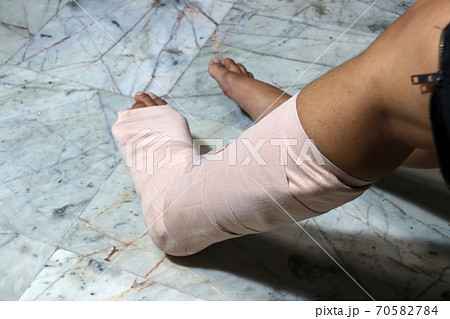 Left legs and feet be in plaster cast because splintered. Left legs and feet be in plaster cast because splintered. 70582784