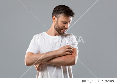 Annoyed man scratching itch on his arm Annoyed man scratching itch on his arm 70598409