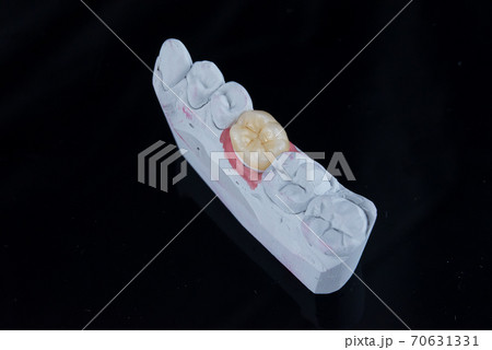 Close up painting artificial dental crown in a dental laboratory. Molar dental crown on gypsum model. Close up painting artificial dental crown in a dental laboratory. Molar dental crown on gypsum model. 70631331