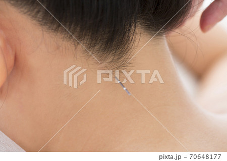 鍼治療 70648177