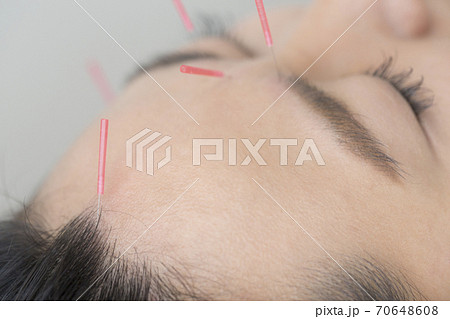 鍼治療 70648608