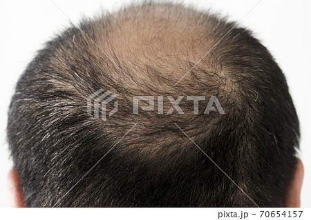 薄毛の男性 薄毛の男性 70654157