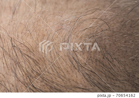 薄毛の男性 薄毛の男性 70654162