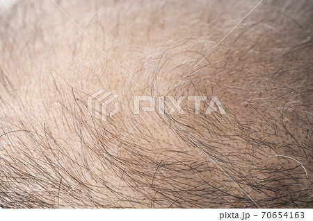 薄毛の男性 薄毛の男性 70654163