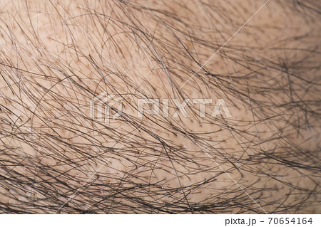薄毛の男性 70654164