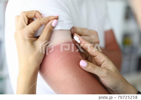 Women's hands apply cream from burns to skin lesions. 70725258