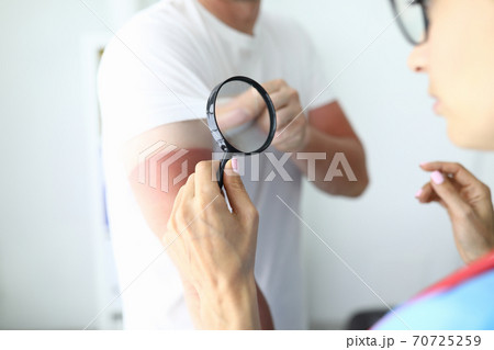 Nurse holds her hand and looks at sunburn on her hand 70725259