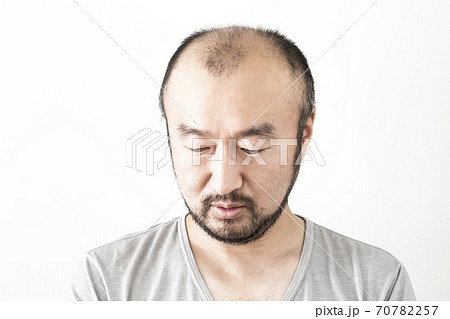 薄毛の男性 薄毛の男性 70782257