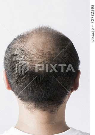 薄毛の男性 70782298