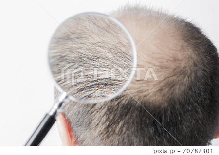 薄毛の男性 70782301