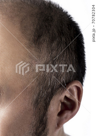 薄毛の男性 薄毛の男性 70782304