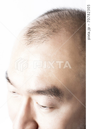 薄毛の男性 70782305