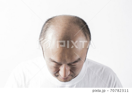 薄毛の男性 70782311