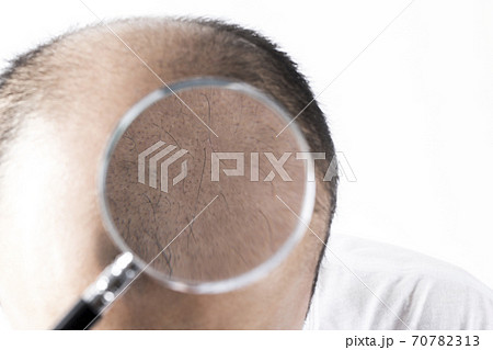 薄毛の男性 薄毛の男性 70782313