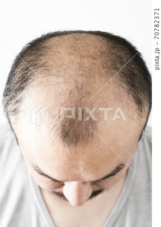 薄毛の男性 70782371