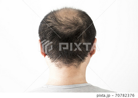薄毛の男性 70782376