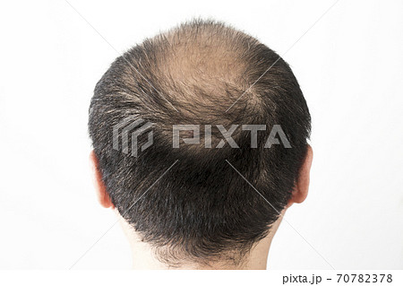 薄毛の男性 70782378