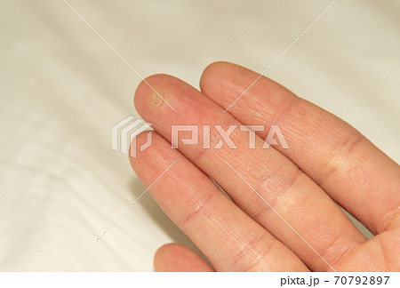 手の指先に出来たイボ 尋常性疣贅の写真素材