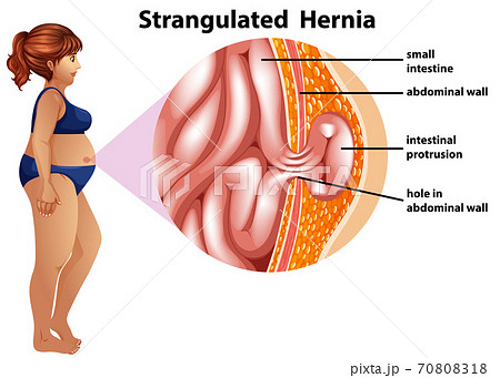 Strangulated Hernia information infographic 70808318