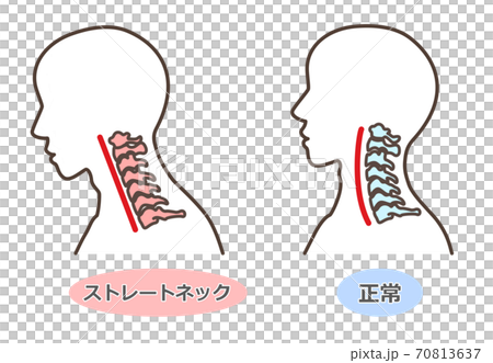 ストレートネック　スマホ首　など 70813637