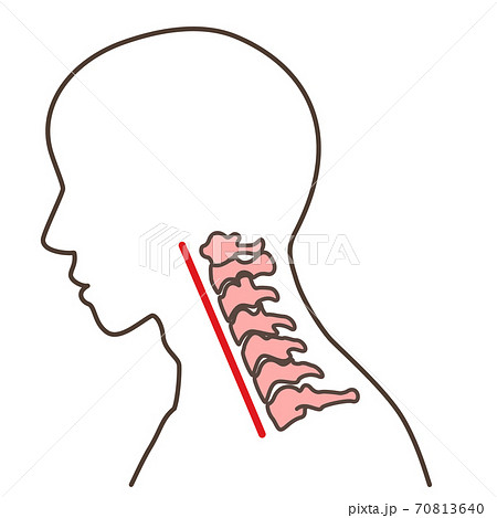 ストレートネック　スマホ首　など 70813640
