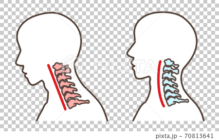 ストレートネック　スマホ首　など 70813641