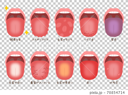 Tongue troubles / diseases - Stock Illustration [70854714] - PIXTA