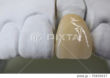 歯 歯 70856037