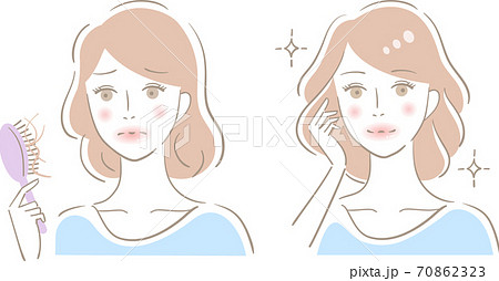 抜け毛 女性　ビフォアアフター 70862323