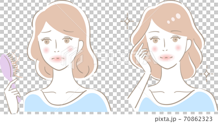 抜け毛 女性　ビフォアアフター 70862323