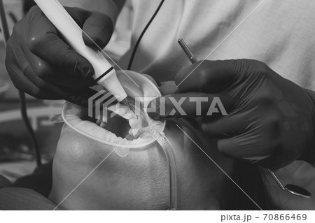 The dentist removes tartar using ultrasound, the patient at the dentist. Retractor for isolation of lips and gums. 70866469