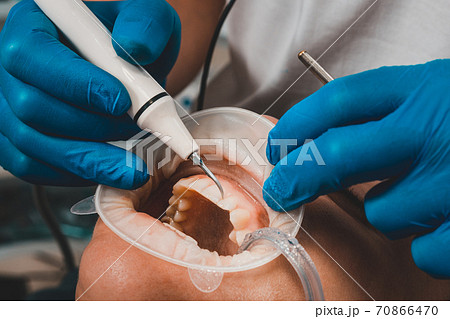 The dentist removes tartar using ultrasound, the patient at the dentist. Retractor for isolation of lips and gums. 70866470