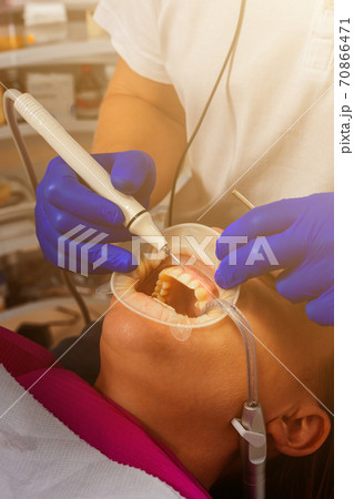 The dentist removes tartar using ultrasound, the patient at the dentist. Retractor for isolation of lips and gums. 70866471