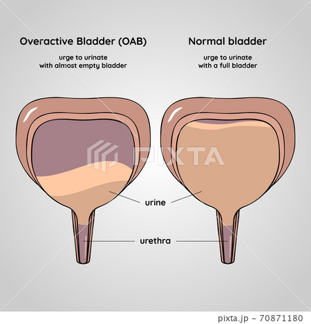 Overactive and normal bladder. Urinary system disease. 70871180