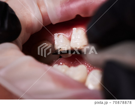 Dentist attaching white braces to patient teeth. 70878878