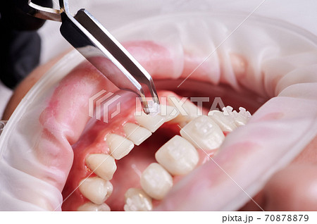 Process dental forceps attaching bracket to lower tooth. 70878879