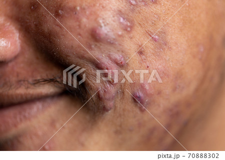 Backgrounds of lesioBackgrounds of lesions skin caused by acne on the face in the clinic.ns skin caused by acne on the face in the clinic. 70888302