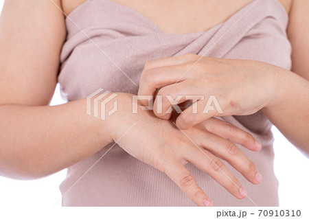 Female scratching her hand isolated white background. Medical, healthcare for advertising concept. Female scratching her hand isolated white background. Medical, healthcare for advertising concept. 70910310