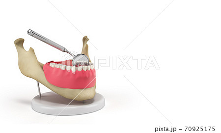 Lingual braces system on a demonstration denture 3d render on white 70925175