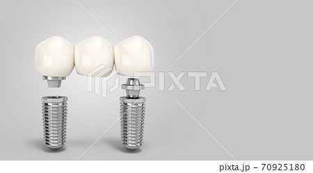 Tooth human multitooth implant Dental concept Human teeth or dentures  multitooth 3d render on grey gradient 70925180