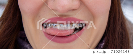 Braces on the girl's teeth smiling, macro photo teeth, close-up lips,  71024143
