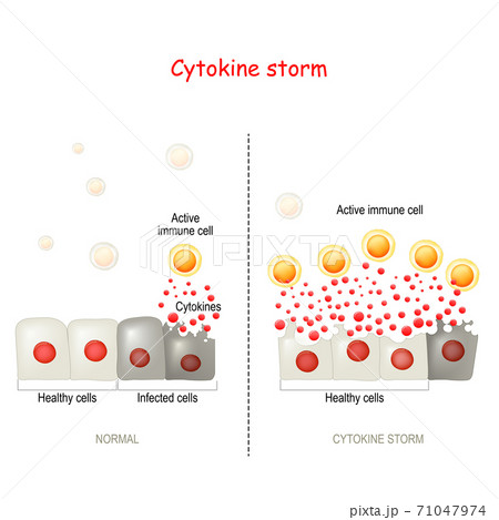 Cytokine Storm Or Hypercytokinemia Covid 19 のイラスト素材