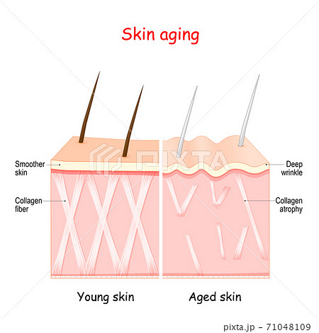 aging process. skin collagen and wrinkles 71048109