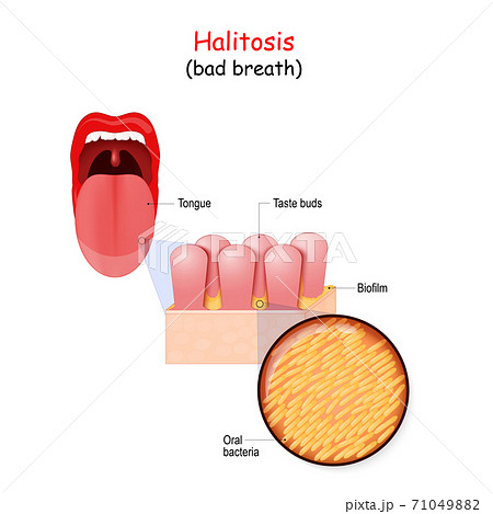 Bad breath and bacteria that cause halitosis. Human mouth Bad breath and bacteria that cause halitosis. Human mouth 71049882