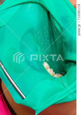 Treatment of posterior tooth, mouth covered with rubber dam, sterile treatment with modern technology. Treatment of posterior tooth, mouth covered with rubber dam, sterile treatment with modern technology. 71096158