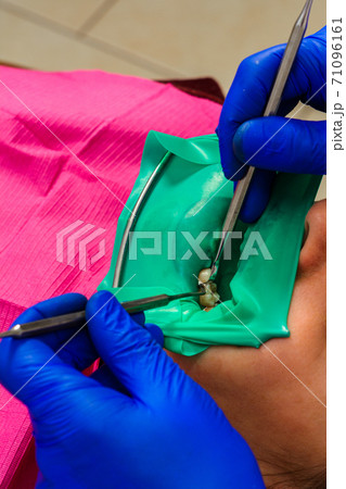 dentist treats the tooth with modern methods, uses a rubber dam, sterile tooth treatment. 71096161