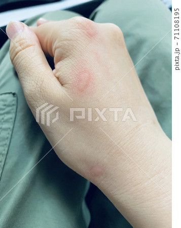 虫刺され(蚊) 虫刺され(蚊) 71108195