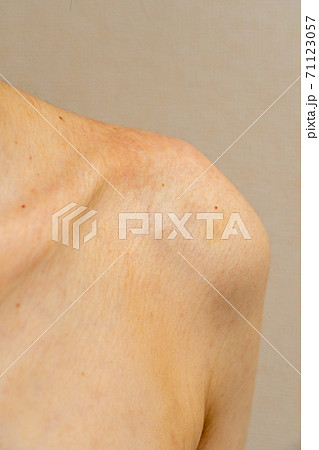 アレルギー・湿疹がでている女性の肩 71123057