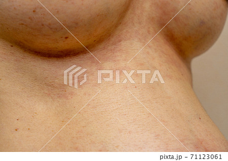 アレルギー・湿疹がでている女性のバスト アレルギー・湿疹がでている女性のバスト 71123061