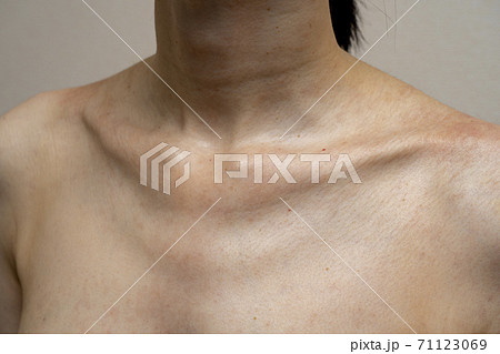 アレルギー・湿疹がでている女性の首周り 71123069